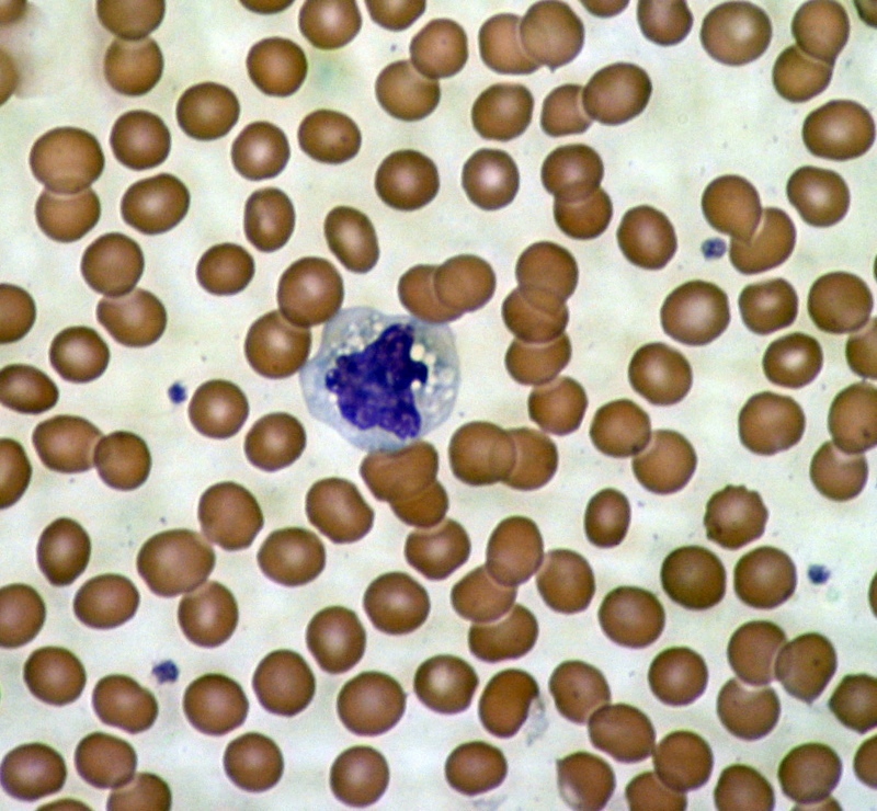 Une image microscopique des cellules sanguines - les globules rouges entourent une cellule du système immunitaire.  