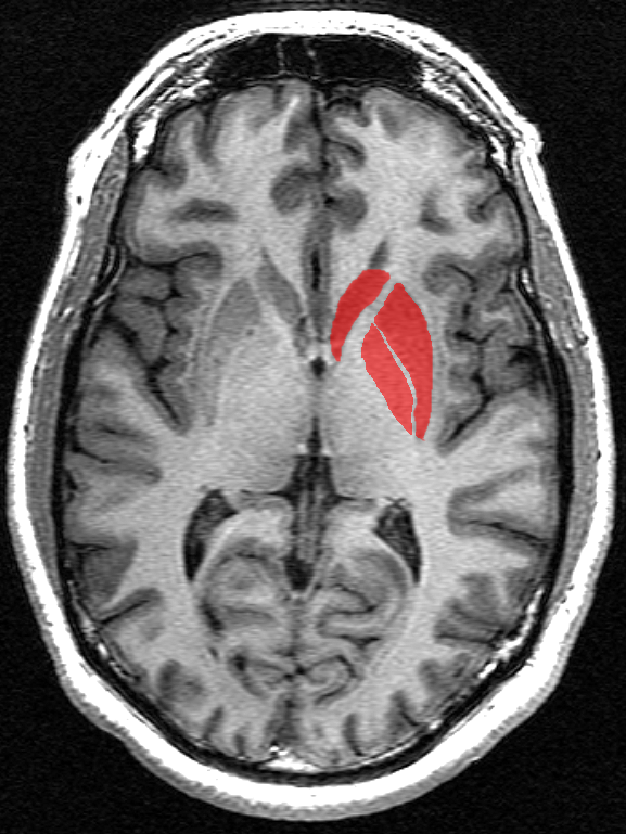 Les ganglions de la base (en rouge) sont un ensemble de structures enfouies dans le cerveau. Nous savons depuis bien longtemps que ce sont ces régions cérébrales qui sont les plus affectées au cours de la MH.   