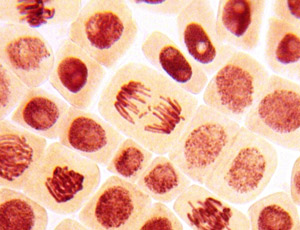 Le cancer survient lorsque les cellules se divisent de manière incontrôlée. De plus, nous comprenons que c'est souvent en raison des différences dans notre ADN. Maintenant, il semble que l'anomalie génétique qui provoque la MH pourrait avoir un lien avec le développement du cancer.