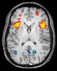 Un exemple de IRMf - les régions du cerveau qui sont activées à un moment donné (en rouge) peuvent être distingués de ceux qui sont moins actives (en bleu). Ce type d'image permet aux scientifiques de cartographier les parties du cerveau utilisés par une personne pour résoudre un problème.