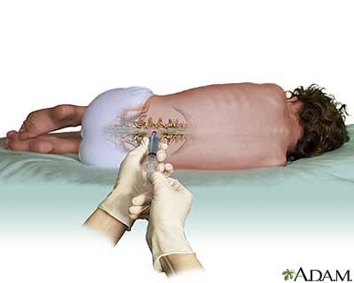 Le médicament ASO a été injecté dans le liquide céphalo-rachidien des patients SLA aux termes d'un processus similaire à une ponction lombaire ou robinet spinal. Pas exactement une promenade dans le parc, mais un peu plus facile qu'une chirurgie du cerveau, qui peut être nécessaire pour d'autres 'arômes' de silençage génique.