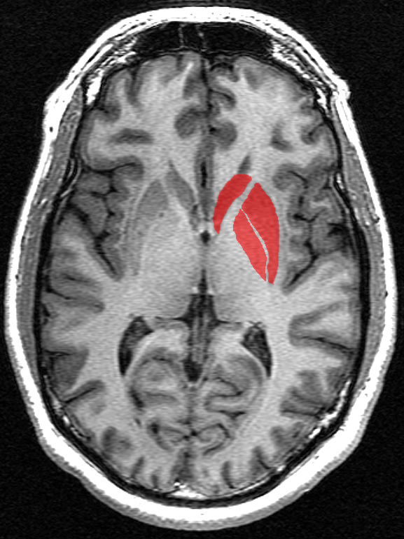 Les ganglions de la base (en rouge) sont un ensemble de structures enfouies dans le cerveau. Nous savons depuis bien longtemps que ce sont ces régions cérébrales qui sont les plus affectées au cours de la MH.