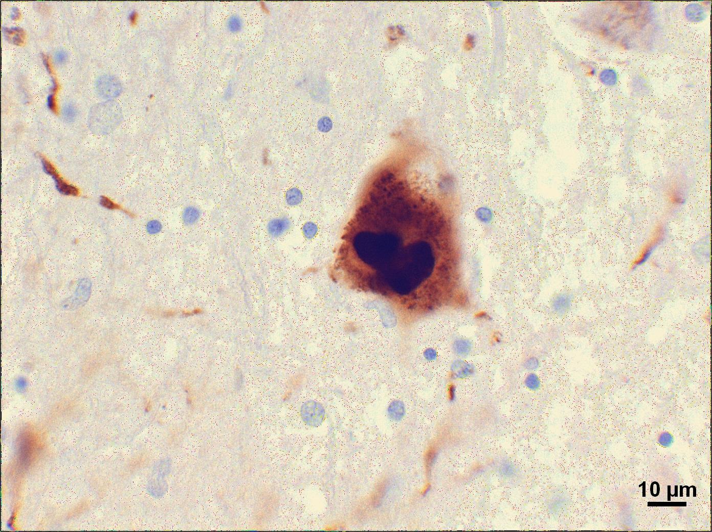 Des accumulations de protéines appelées "corps de Lewy" sont présentes dans les cerveaux de patients atteints de la maladie de Parkinson. Des travaux récents suggèrent que ces amas de déchets peuvent également être présents dans les nouvelles jeunes cellules transplantées dans le cerveau de patients parkinsoniens.