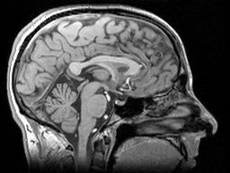 Le plus gros volume atteint par le cerveau pourrait être moindre chez les hommes avec la mutation HD  