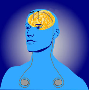 La stimulation cérébrale profonde consiste à placer de minces électrodes à travers le crâne dans le cerveau. Les générateurs d'impulsions placés sous la peau fournit des impulsions électriques au cerveau.  