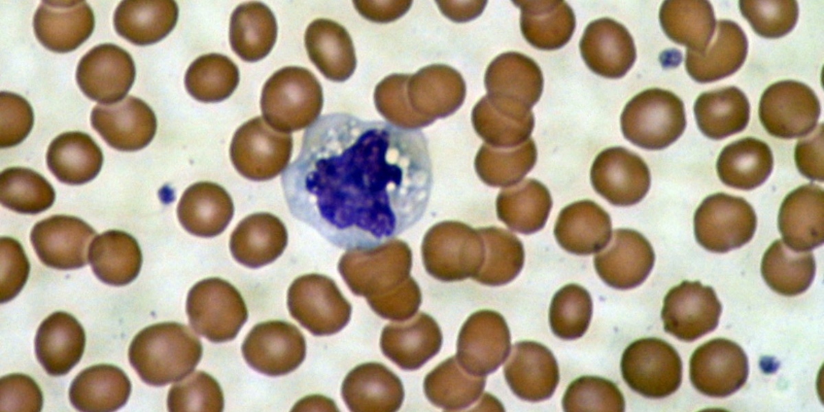 Résultats éclairants dans les cellules sanguines des patients MH