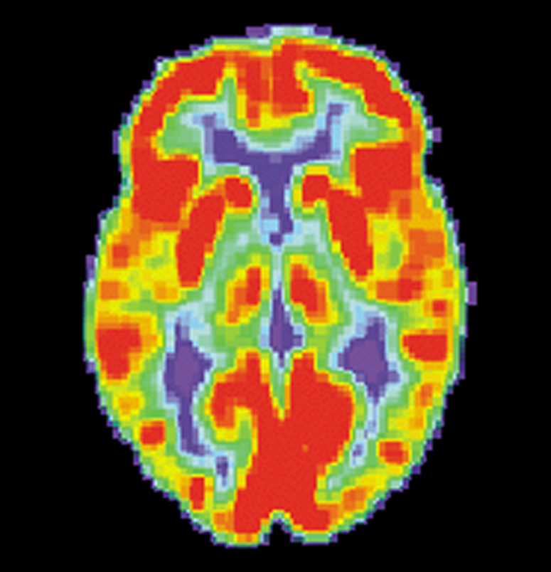 Les PET scans FDG nous permettent de voir la quantité de sucre utilisée par chaque région du cerveau. Il s'agit d'un scan portant sur un cerveau sain. Les zones rouges consomment plus de sucre.  