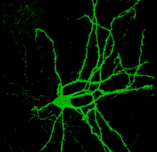 Transformation de cellules de peau en cellules du cerveau : une percée dans la recherche sur la maladie de Huntington ?